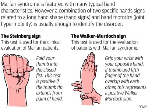 Lifelong drug therapy the key to coping with Marfan syndrome