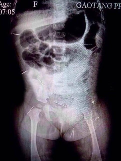 X-ray showing needles inside the 11-month-old girl's body.